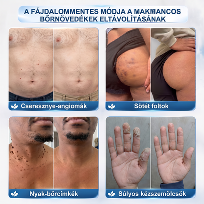 7 napos golyós aplikátor szemölcsök és foltok ellen – Fejlett, fájdalommentes és hegmentes bőrhibatartó megoldás